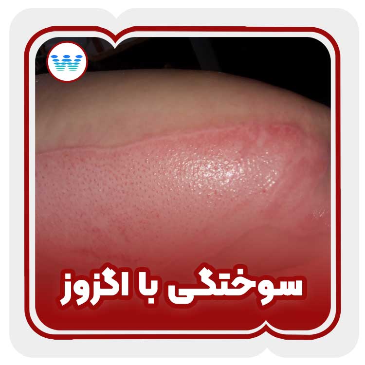 درمان سوختگی با اگزوز - کلینیک زخم