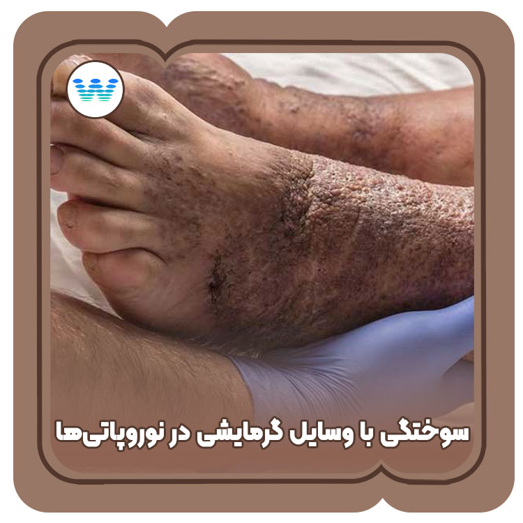 سوختگی افراد دیابتی با وسایل گرمایشی