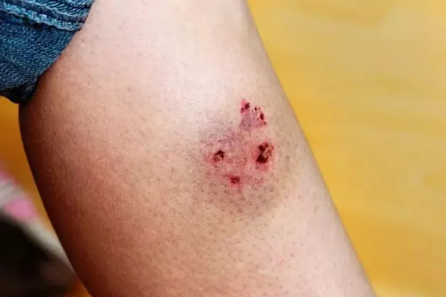 درمان عفونت زخم