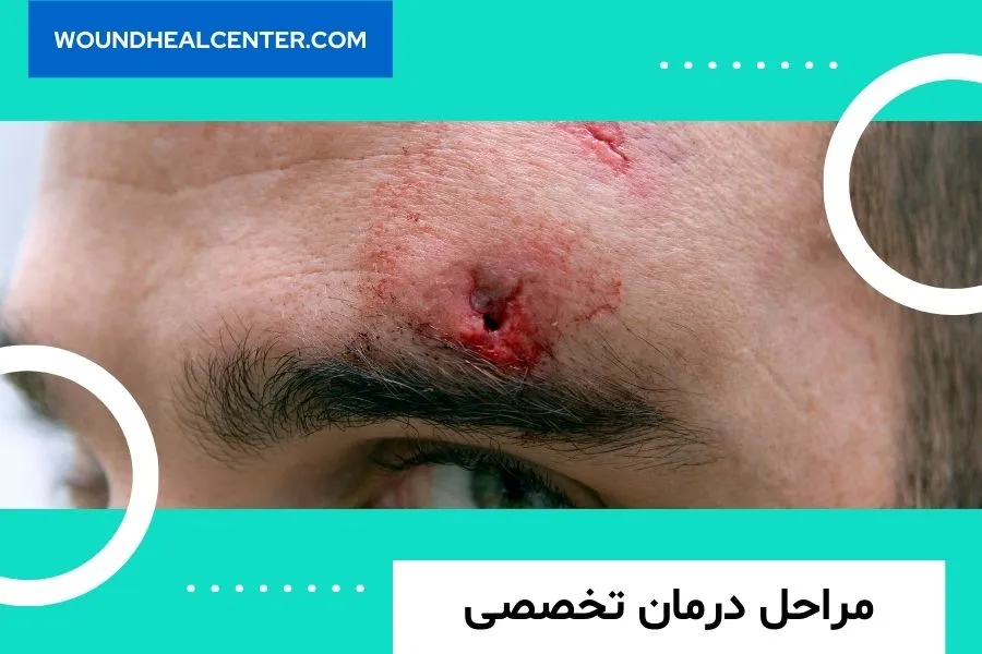 درمان زخم های ناشی از تصادفات